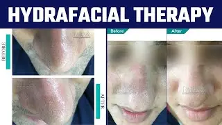 What is HydraFacial Step By Step? | Types and Benefits | Before After Results #shorts