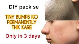 How to treat tiny bumps Permanently 😳✅💯| tiny bumps removal pack  #tinybumps #yt #facebumps #acne