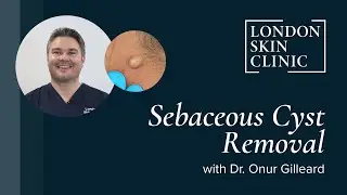 Sebaceous Cyst Removal | Long Lasting Results | Quick Recovery | London Skin Clinic