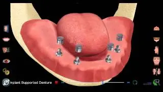 Dr. Withers Shares an Illustration on Implant Supported Dentures in Fairfax, VA