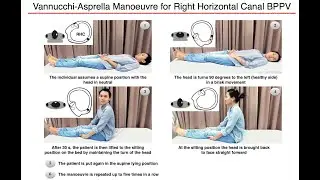 Vannucchi-Asprella Manoeuvre for Right Geotropic Horizontal Canal BPPV