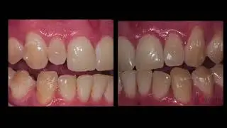 Invisalign Laterals Not Tracking
