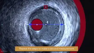 Taking Linear and Diameter Measurements on the TVC Imaging System