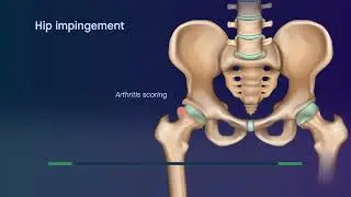 MRI doesn’t improve the reliability of hip arthritis grading in patients with hip impingement