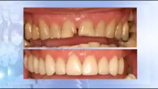 Cosmetic Dentist Colorado Springs Before and After