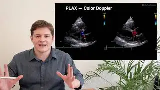 〖Echocardiography〗 Parasternal Long Axis View (PLAX) part 2