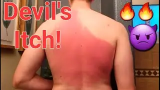 STOP Devil's Itch. RELIEF! Hell's Itch *Detailed* Experience, Research l PMLE, Sun Allergy