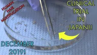 HUMAN HAIR MULTIPLICATION TRIAL IN JAPAN BY TISSUSE/J HEWITT!!