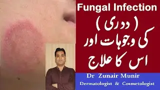 Fungal infection | dadri ka ilaj in urdu | dadri ka ilaj | dadri ka ilaj kaise kare