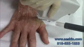 Forever Young BBL IPL Photofacial Demonstration 7 Hands - A E Skin - Encino, CA - 818-835-1833