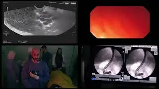Live EUS-guided injection of fundic varix during Mahala live endoscopy