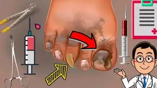 ASMR Ingrown Toenail Removal Treatment And Makeup Animation