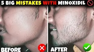 5 Big Mistakes Using Minoxidil for Beard Growth | Minoxidil Beard Growth Mistake | Beard Growth |