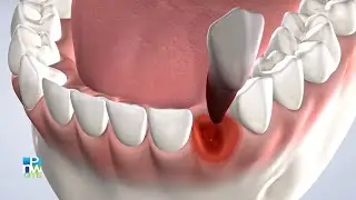 Post-Operatorio: Extracciones M&uacute;ltiples | Pacific Northwest Oral & Maxillofacial Surgeons