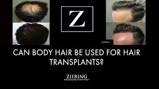Can Body Hair Be Used For Hair Transplants?