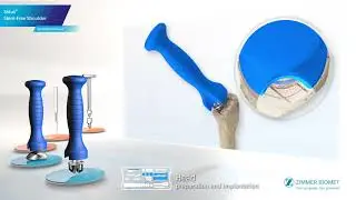 ANIMATION   SIDUS ZIMMER BIOMET ST 2018