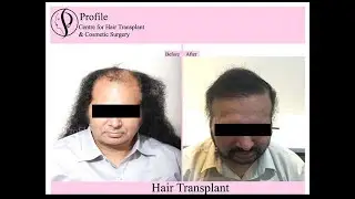 FUE Hair Transplant in India Punjab, FUE Cost, Procedure - Live Feedback of our Patient