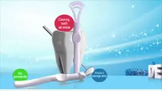 Aplicador con esponja de melamina para blanqueo de dientes