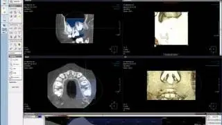 NewTom 5G VGi  Cone Beam CT Studie Dental 8x8