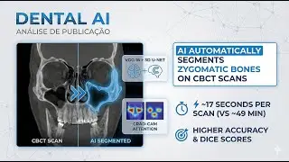 AI segments zygomatic bones on CBCT scans