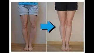 Bow Legs No More - Can Knock Knees Be Corrected With Exercises?
