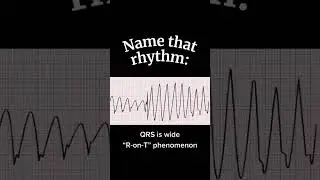 NCLEX ECG Rhythm Challenge: Can You ID It? ❤️