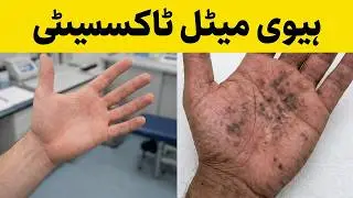 Signs & Symptoms of Heavy Metals Toxicity on Skin & Health | How to Identify & Detoxify