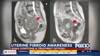 Uterine Fibroid Awareness and Treatment