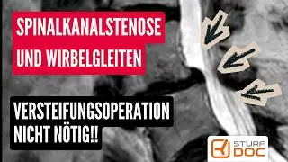 Spinalkanalstenose und falsches Wirbelgleiten (Pseudospondylolisthese) - Keine Versteifung nötig!