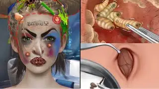 ASMR | Deep Belly Button Cleaning | Remove Huge Skin Care Animation | Pimple popping Acne treatment