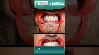 Full Mouth Rehabilitation in India | Immediate Loading Dental Implants at Best Dental Implant Clinic