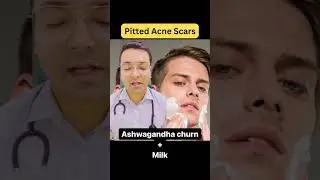 Suffering from acne scars?