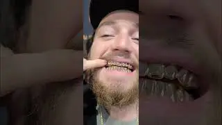 #goldgrillz 10K Yellow Gold Grillz from Alpha Grillz  #goldgrillz #grillz #гризли #shorts