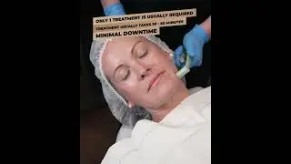 FaceTite Treatment Performed by Dr. Victoria Givens, with Amazing Before & After Photos
