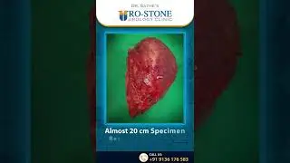 Laparoscopic Radical Nephrectomy for Large Kidney tumour
