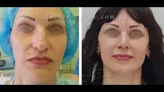 Открытая ринопластика + липофилинг лица. До и после