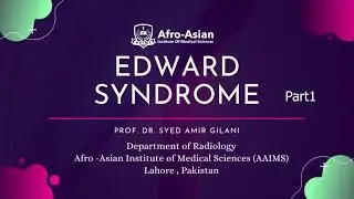 Edwards Syndrome | Ultrasound Approach | Prof. Gilani's Lectures
