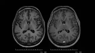 The value of 3d t1 pre and post  contrast in mri brain exam