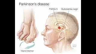 Parkinson's and safety PT License Exam Preparation No 4