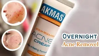 How to remove pimples overnight| acne treatment | Akmas acne cream review #acne_removal