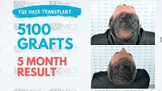 Manual FUE Hair Transplant Before & After, 5100 Grafts 5-Month Result - ASMED - Dr. Koray Erdogan