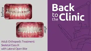 Adult Orthopedic Treatment: Skeletal Class III with Lateral Open Bite  - BTC #013