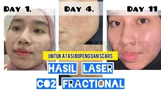 BEFORE AFTER LASER CO2 FRACTIONAL | UPDATE PROGRESS MENGURANGI BOPENG