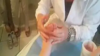 Alluce Valgo Giovanile trattamento con tutori al silicone - Prof. Lorenzo