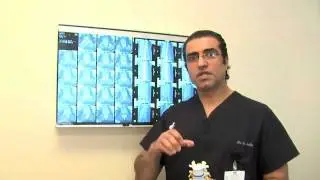 Spondylolisthesis - Spine Conditions