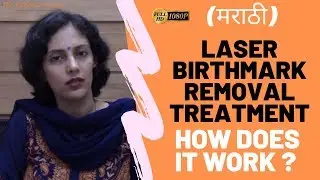 Laser Birthmark Removal Treatment (in MARATHI) by Dr Rinky Kapoor, Mumbai, India