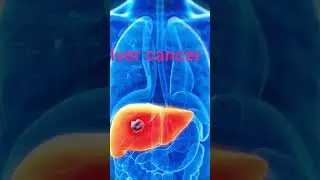 #music #viralvideo #viralshorts #cancer #viral #vlog #viralvideos #medicine#shortvideo #shorts