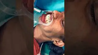 Clear Aligner ✨😁 #nise #dentalclinic #smiledesigndental #clearaligner