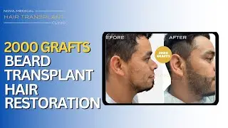#BeardTransplant | Patchy Beard to Full & Dense Facial Hair Transformation