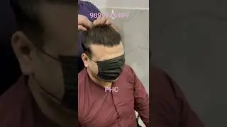 Ultra thin Hair patch |#hairloss #hairpatch #kolkata #haircare #hairtransformation #wig #wigs #patch